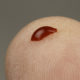 Blood drop on a finger. There are many key questions to ask before DTC testing.